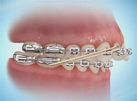 4 Orthodontic Terms To Know Elastics Invisalign TMJ Phase 1 2