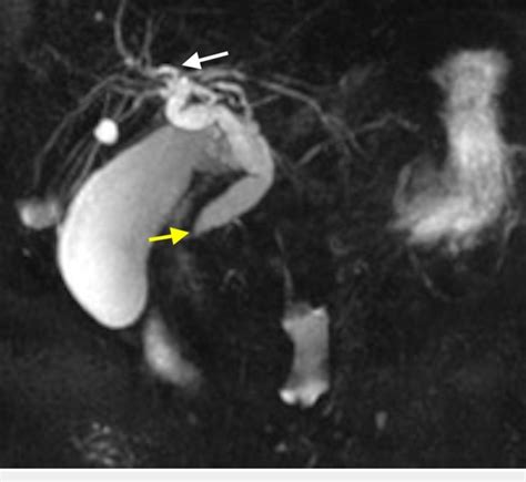 Biliary Ductal Dilatation