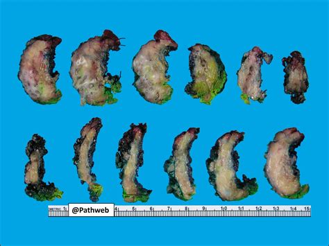 Breast Male Gynaecomastia Nus Pathweb Nus Pathweb