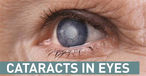 Cataracts In Eyes - Sunway Eye Centre - Eye Specialists in Malaysia