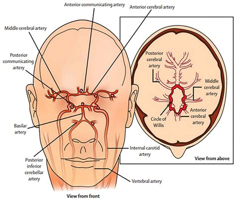 Common Places Where Cerebral Saccular Aneurysms Grow Download