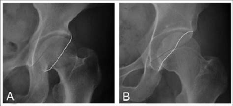 Cranial Acetabular Retroversion