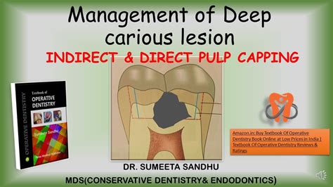 Indirect Pulp Capping Procedure Flow Chart