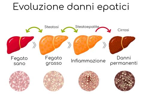 Steatosi Epatica Fegato Grasso Cause Sintomi E Pericoli Valori