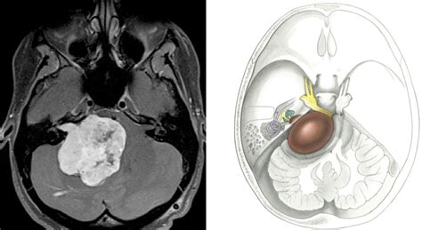 Acoustic Neuroma Overview Expert Surgeon Aaron Cohen Gadol Md