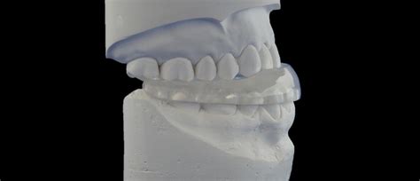 Occlusal Splints Ultralight Dental Appliances