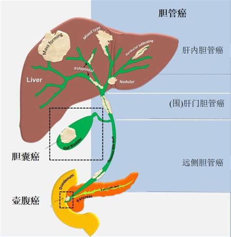 胆道恶性肿瘤漫谈2021 1 概念与流行病学易滨医生文章海军军医大学第三附属医院（东方肝胆外科医院）安亭院区 微医