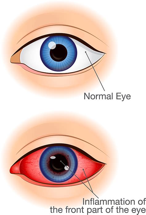 Uveitis East Valley Ophthalmology Eye Doctors Mesa AZ