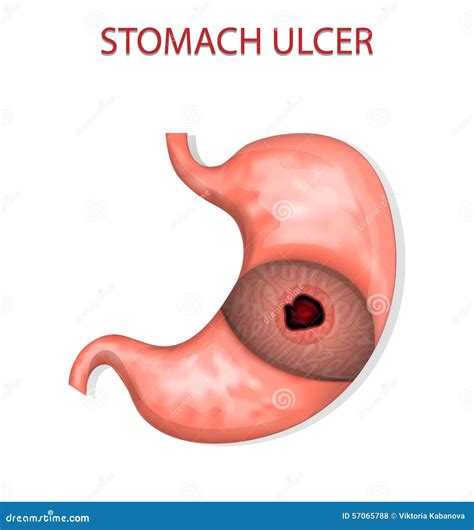 Stomach Ulcer Stock Vector Illustration Of Human Medical