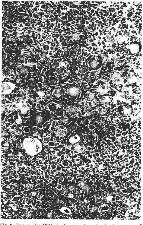 Figure 1 from Malignant fibrous histiocytoma (MFH). A comparison of MFH ...