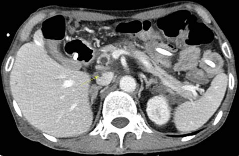 Pancreatitis Panniculitis And Polyarthritis Syndrome Caused By Pancreatic Pseudocyst A Case