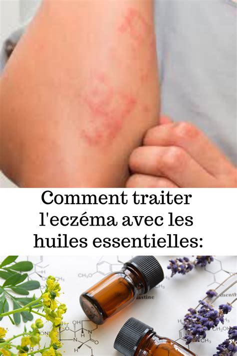 Pourquoi et comment utiliser les huiles essentielles contre l eczéma