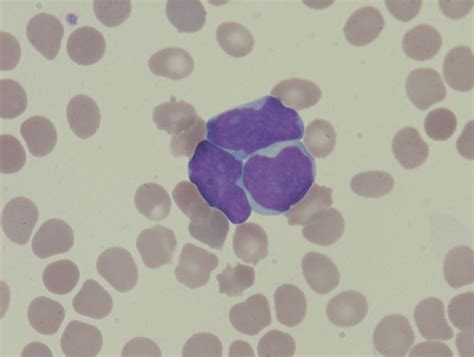 [figure Bone Marrow Aspirate With Blasts ] Statpearls Ncbi Bookshelf