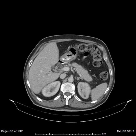 Idiopathic Retroperitoneal Fibrosis Pacs