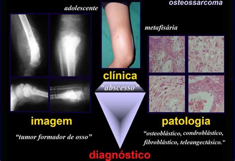 Osteossarcoma O Que É - Osteossarcoma - Oncocirurgia
