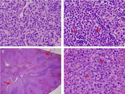 Plasma Cell Tumors And High Grade Splenic Marginal Zone Lymphoma A B