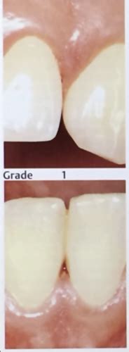 Periodontal Examination Flashcards Quizlet