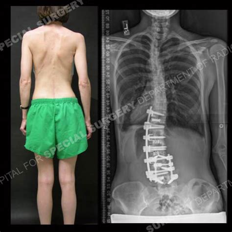 Lumbar Scoliosis Surgery