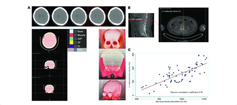 Measurement Of Hounsfield Unit In Skull And Lumbar Bone And Their Download Scientific Diagram