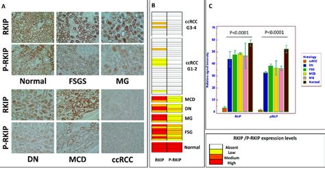 RKIP And P RKIP Tissue Expression Immunohistochemical Staining Of RKIP