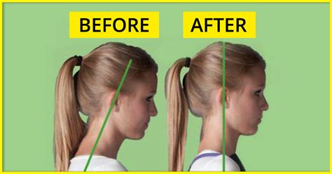 7 Forward Head Posture Exercises To Reduce Neck Pain