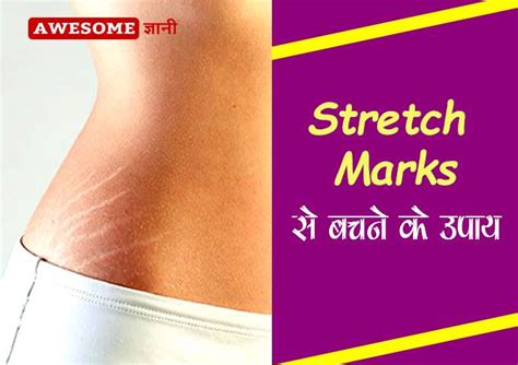 How To Remove Pregnancy Stretch Marks In Hindi प्रेगनेंसी के स्ट्रेच