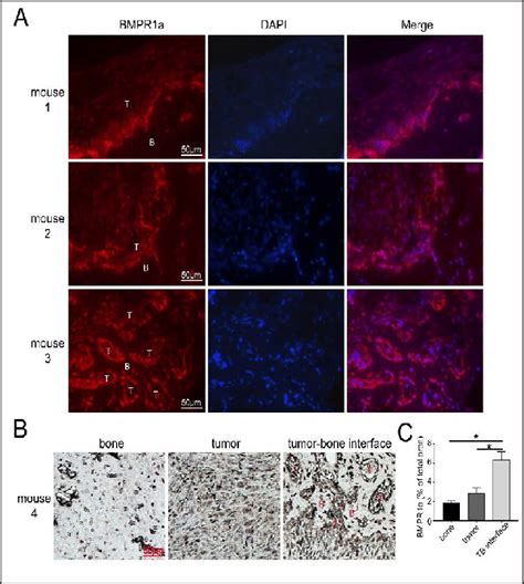 Expression Of Bmpr1a Of Breast Cancer Cells At The Tumor Bone Interface