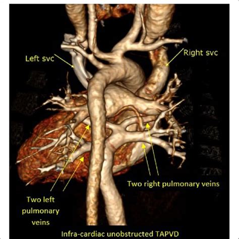 3d Volume Rendering Image Showing Total Anomalous Pulmonary Venous