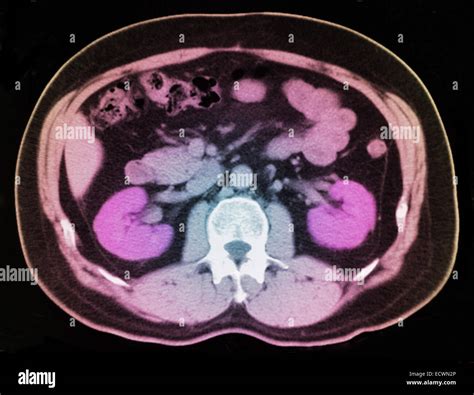 Tomograf A Computarizada Del Abdomen Que Muestra Una Peque A Piedra