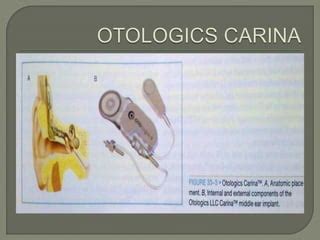 Middle ear implants | PPT