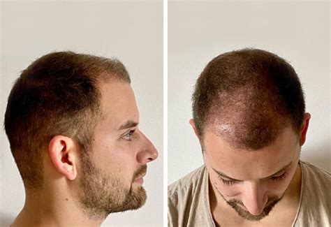 Marcel O Before After Pictures 4200 Grafts Elithair