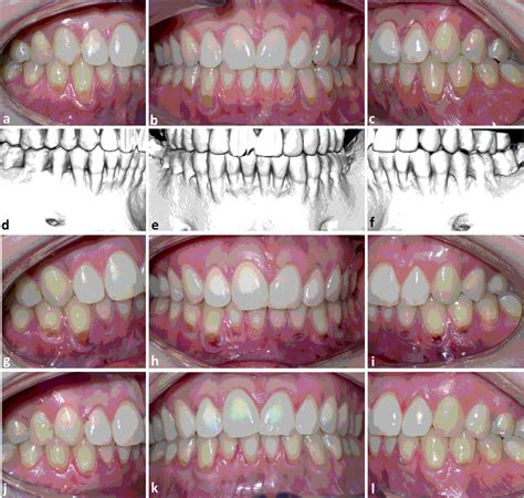 Innovative I Prf Semisurgical Method For Gingival Augmentation And Root