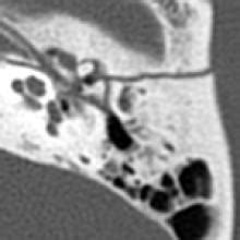 Temporal Bone Fracture | American Journal of Neuroradiology