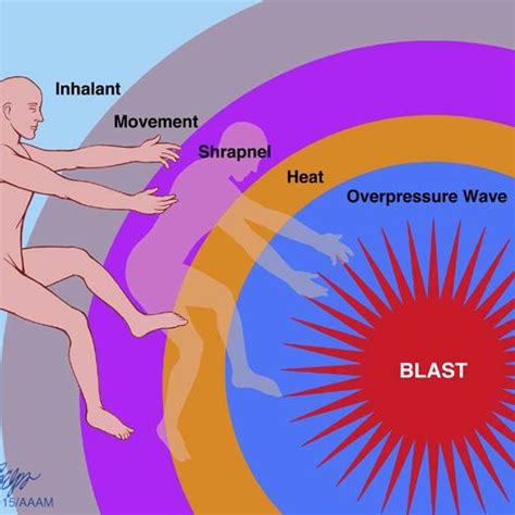 7 Blast Tbi Is A Very Complex Injury That Starts With The Overpressure