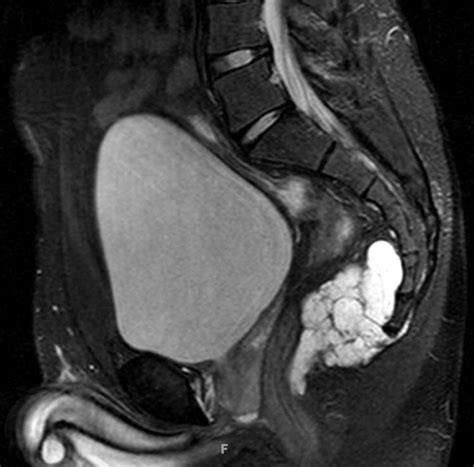 Presacral Masses Multimodality Imaging Of A Multidisciplinary Space