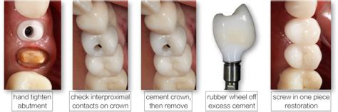 When To Choose Screw-Retained Over Cement-Retained Crowns, 51% OFF