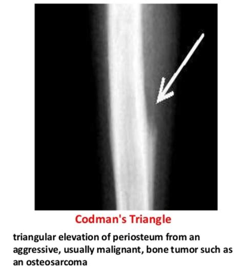 Codmans triangle in Osteosarcoma ... Radiographer, Review Board, Rad ...