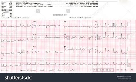 Cardiogram Waveform Ekg Showing Borderline Ekg Stock Photo