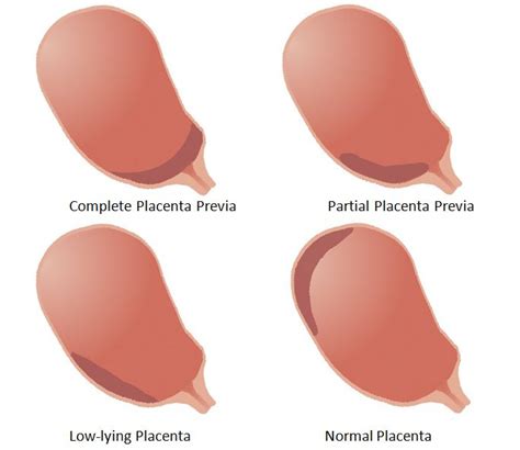 Placenta Previa