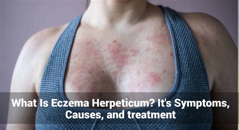 Wat Is Eczema Herpeticum Symptomen Oorzaken En Behandeling Eczemaless