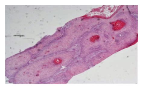 Photomicrograph Of Punch Biopsy From The Second Ulcerative Lesion Hande