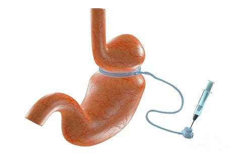 Gastric Band Photograph By Patrick Landmannscience Photo Library Pixels