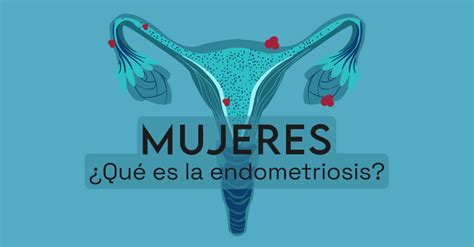 Qué es la endometriosis