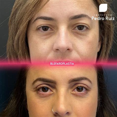 5 Casos De Blefaroplastia Antes E Depois