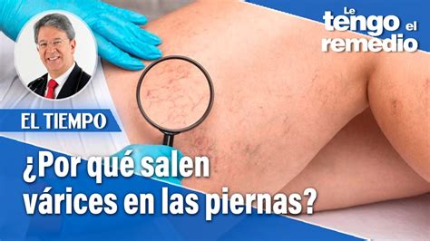 Por qué salen várices en las piernas a temprana edad El Tiempo