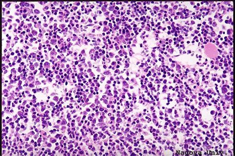 Acute Lymphoblastic Leukemia Lymphoma All Stepwards