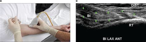 Biceps Tendon Injection