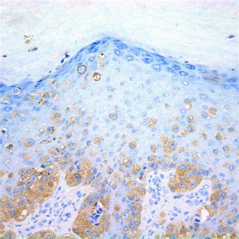 Acral Lentiginous Melanoma A Tumour Cells Are Usually Spindle B