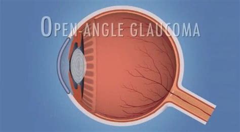 02-Open-angle-Glaucoma | Eye Physicians and Surgeons of Ontario