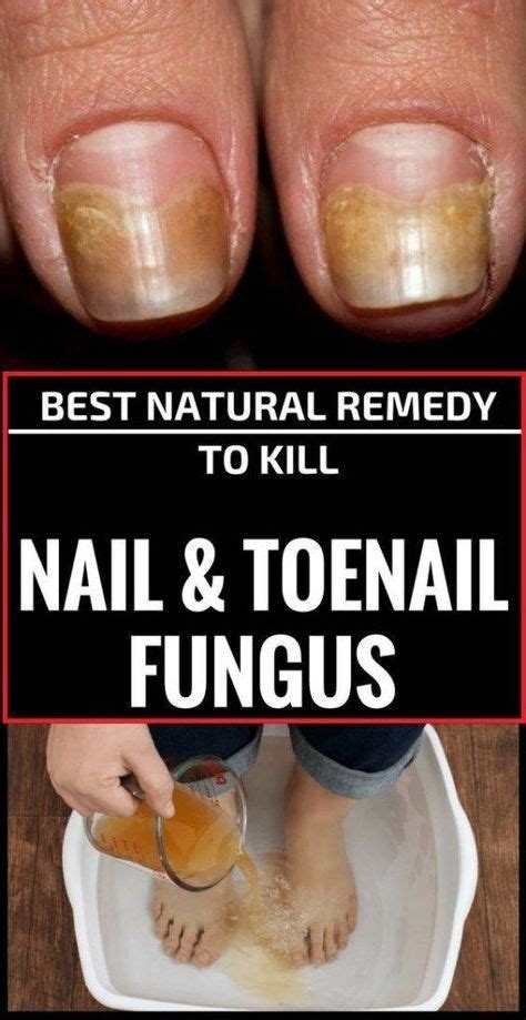 Best Natural Remedy To Kill Nail And Toenail Fungus Usefulhealthytips